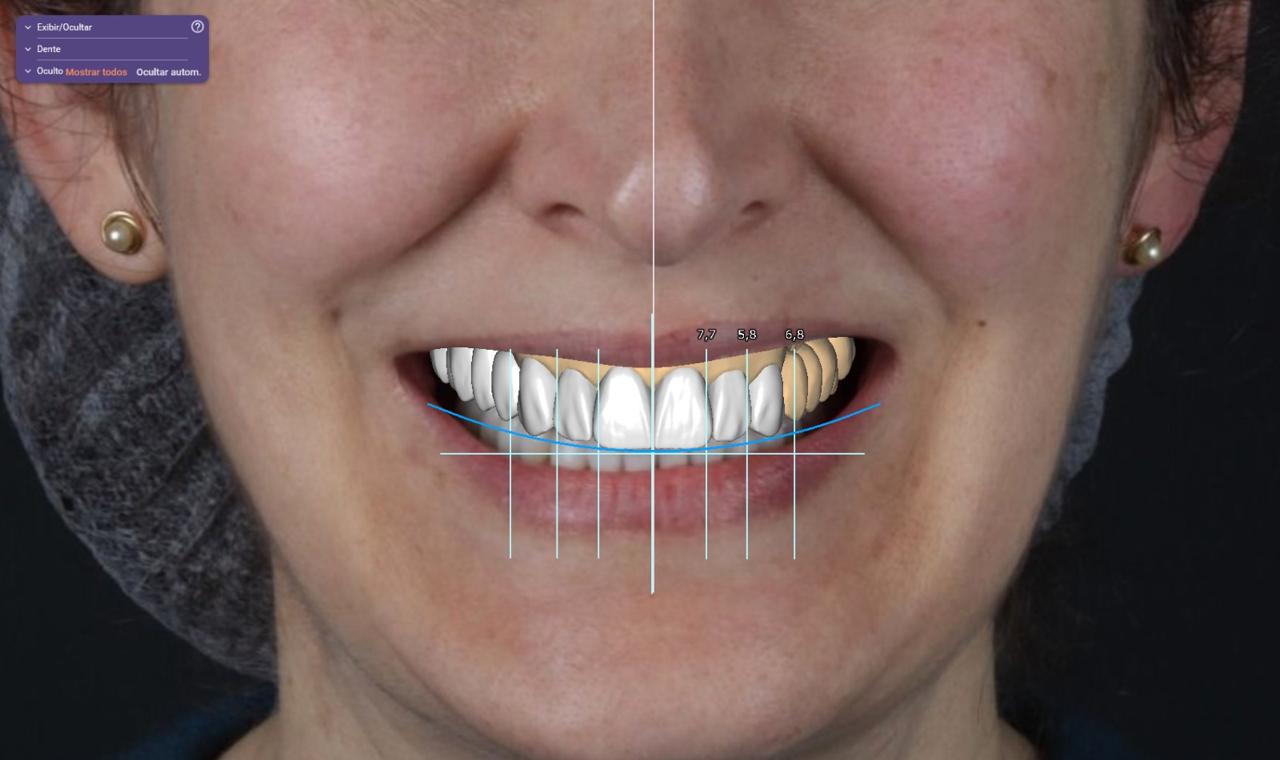 Simulação digital do sorriso de uma paciente, com linhas de referência facial e proporções dentárias sobrepostas à fotografia