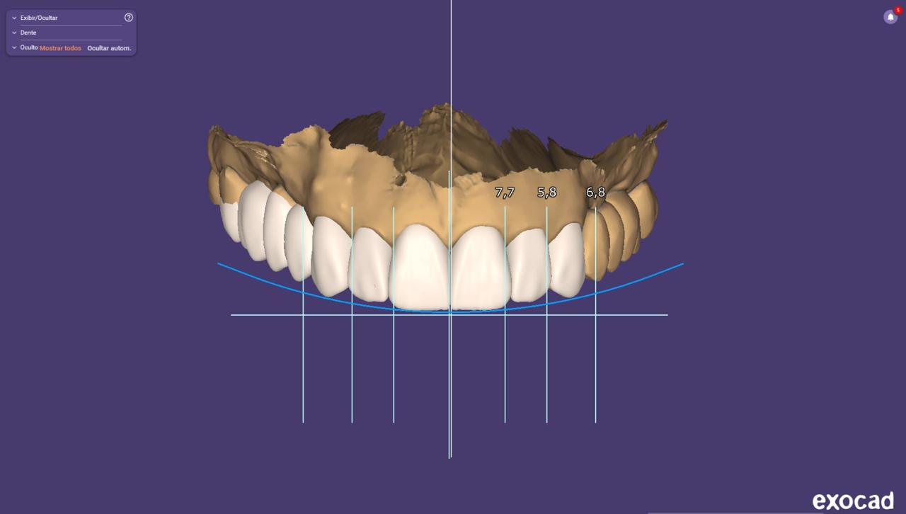 Planejamento digital do sorriso em software 3D, com linhas de referência, medidas dos dentes e simulação das facetas na arcada superior